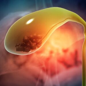 Laparoscopic Cholecystectomy