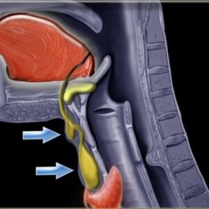 Excision of Thyroglossal Cyst (Sistrunk Procedure)