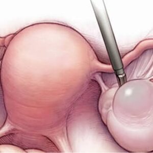 Laparoscopic ovarian cystectomy