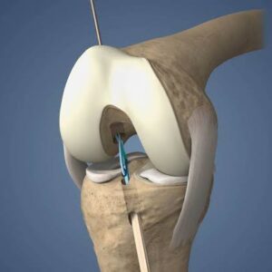 Anterior Cruciate Ligament Reconstruction Surgery