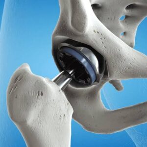 Hip Replacement Surgery