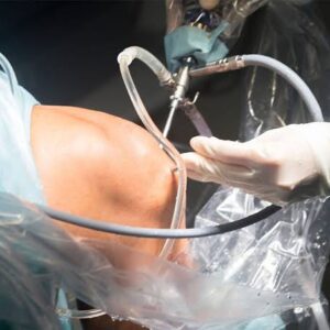 Arthroscopy