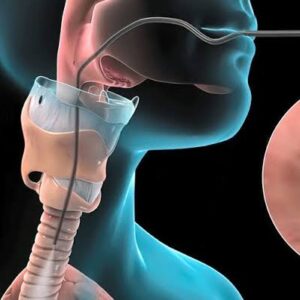 Bronchoscopy