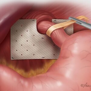 Laparoscopic Hiatus Hernia Repair