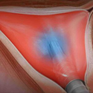 Hysteroscopic Endometrial Ablation