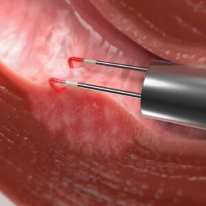 Hysteroscopic Myomectomy