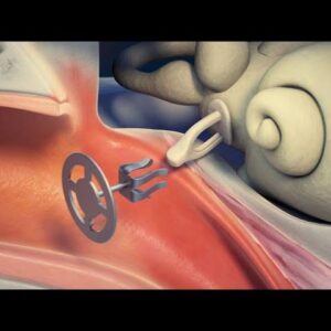 Ossicular replacement prosthesis surgery