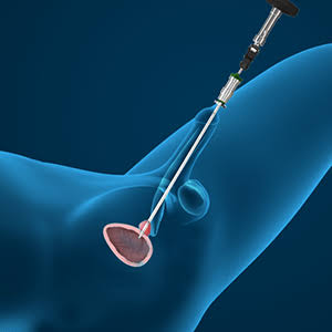 Transurethral Resection of the Prostate (TURP)