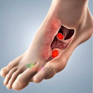 Foot Ulcer Consultation and Treatment Package